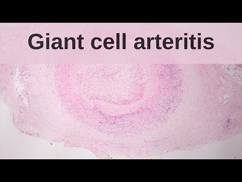 Giant cell (temporal) arteritis - Pathology mini tutorial