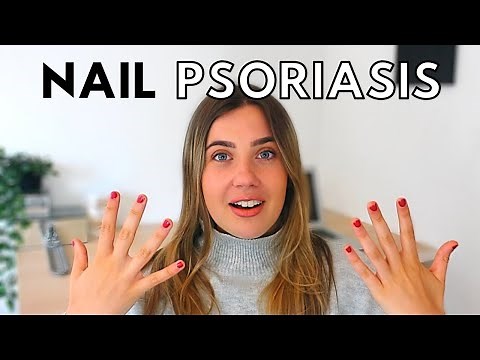 NAIL PSORIASIS TREATMENT AT HOME // psoriasis update and storytime