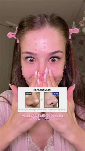 Você sente as agulhas na pele 🤯💉Skincare Coreano tá em 2050 SIM ⭐️ vê resultado na pele mt mais rápido!!! Eu confio de olhos fechados na @Lazafir Essence (dou minha palavra) e temos cupom ALISSA Os dois produtos são da: @medicube global #pele #espinhas #cravos #poros #manchas