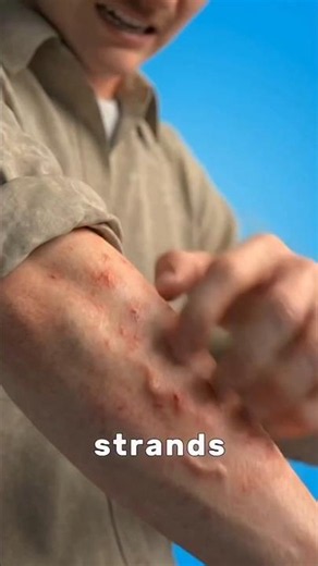 👨‍⚕️Morselons🦠 Disease is One of the most misterious condition...#viral #shorts #feed#facts #health.