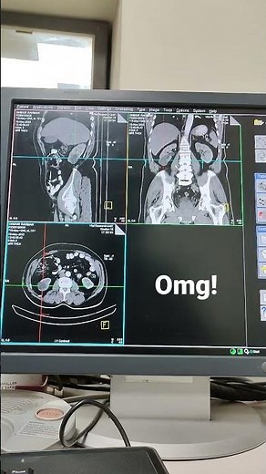 Ct scan of whole abd.pathology -Rt renal cyst and Enlarge prostate.