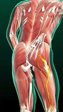Pinched Nerve? Here’s What Foraminal Stenosis Means
