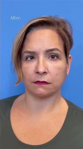 Facelift + Neck Lift + Brow Lift Transformation | Natural, Refreshed Results by Dr. Casey