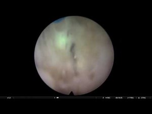 En Bloc HoLEP post-TURP • Video • MEDtube.net
