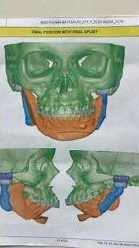 From NO Chin and Jawline to Amazing Face! Plastic surgery maxillofacial miracle