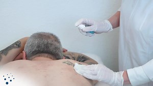 NanoStar lasers are used for tattoo removal, benign pigmented lesions...