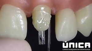 Indirect Custom Post. #Dentistry #LearningTips | Bites & Braces Dental