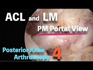 Posterior Knee Arthroscopy 4：ACL and LM View from Postero Medial Portal 膝関節後方への関節鏡アプローチ4
