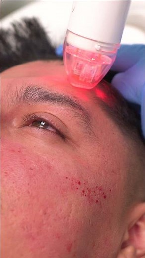 Radiofrequency Microneedling Treatment by Dr. Nadir Qazi