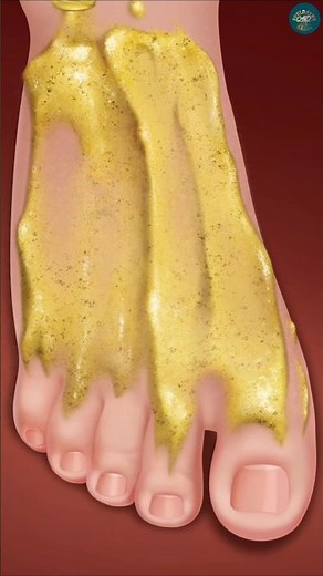 Extreme Foot Skin Transformation ASMR 👣✨ | Dry Skin & Dead Skin Removal Animation #asmr #shorts