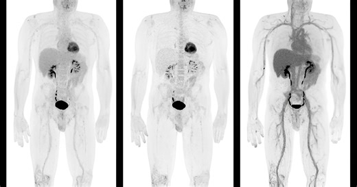Advancing Whole-body Dynamic PET Imaging for Understanding Disease Metabolism