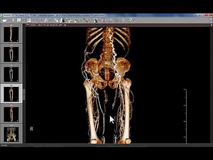 CT Angiography Case02 IVC Thrombosis