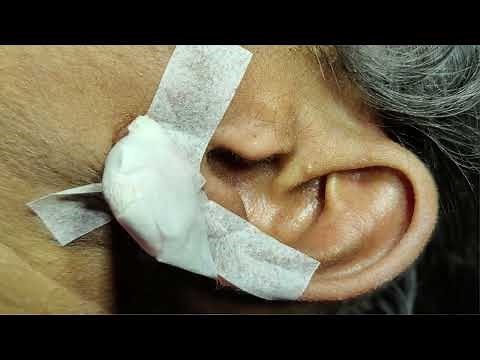Infected Epidermal Inclusion cyst of Earlobe