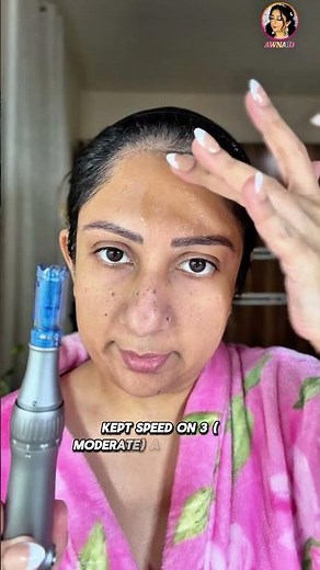 How to do Face Micro Needling At Home #awnaid #microneedling