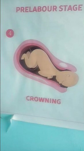 stages of birth in vaginal delivery - cardinal movements