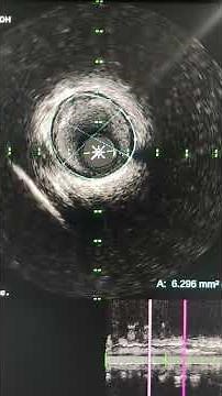 Coronary IVUS basics,Image interpretation and plaque.
