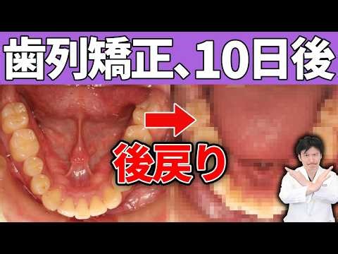 Have you experienced a sudden relapse after orthodontic treatment? We'll discuss the importance o...