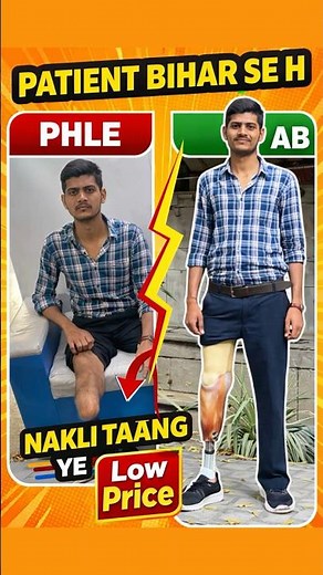 Waterproof Artificial Leg | Below knee prosthetic | Prosthetic Leg Price #ossur #ampute #ottobock