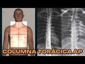 AP THORACIC SPINE X-RAY (POCKET MANUAL) #30