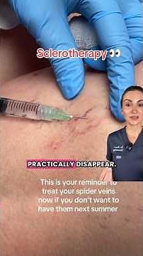 Sclerotherapy: Top Treatment for Spider Veins ✨