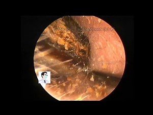 Cerumen embolism with super severe blockage ,20221015