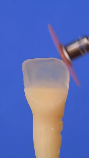 Direct Composite Veneer Step-by-Step Guide for Dentists