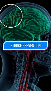 65K views · 1.2K reactions | How to prevent strokes. #Science #Research #Biology #Health #Medicine | Hashem Al-Ghaili | Facebook