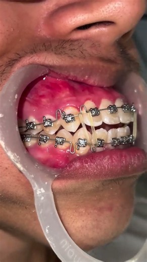 Braces Treatment for gap in teeth