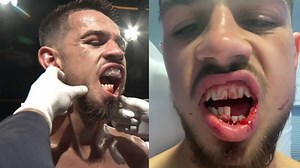 Boxer breaks jaw in half and films shocking injury