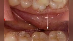 恢复牙齿形态，重塑咬颌功能，还您一口健康美牙。