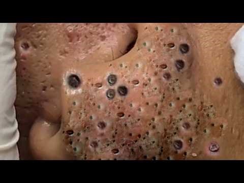 𝐂𝐫𝐚𝐳𝐲 𝐒𝐚𝐭𝐢𝐬𝐟𝐲𝐢𝐧𝐠 𝐁𝐥𝐚𝐜𝐤𝐡𝐞𝐚𝐝 𝐑𝐞𝐦𝐨𝐯𝐚𝐥#174