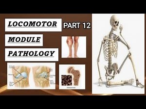Loco pathology - cartilage forming tumors #locomotor #pathology #osteochondroma #chondroma