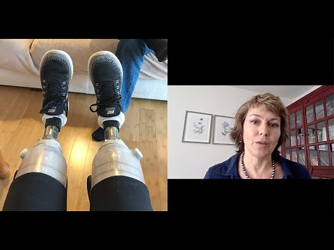 Septic Shock with Multiple Amputations: A Survivor's Story