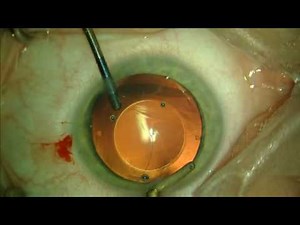 Staar's Visian ICL: Bilateral Surgery