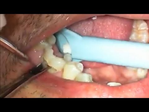 Sectional extraction of a badly decayed lower first molar
