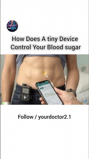 How Does an Insulin Pump Control Blood Sugar 24/7? Medical Breakdown #medicaleducation #insulinpump