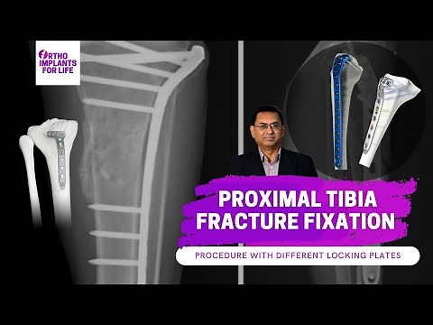 Proximal Tibia Locking Plates Fixation Procedure