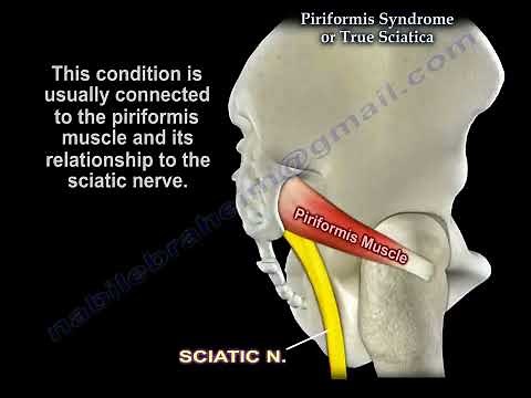 Piriformis Syndrome or Sciatica — Identify the Real Cause of Sciatic Nerve Pain