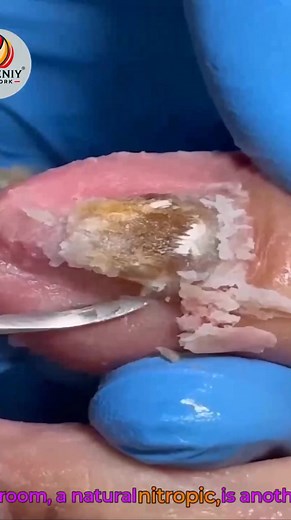 3K views · 20 reactions | Daily Nail Care Habits for Overgrown Toenails That Reduce Pain Naturally #DiabeticFootCare #SeniorHealth #SafeSteps #WellnessSeniors | Evgeniy | Facebook