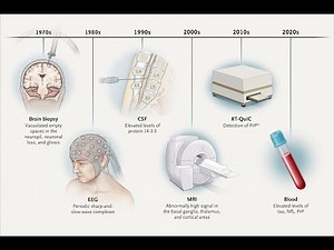 Using Cerebrospinal Fluid Analysis to Diagnose Creutzfeldt Jakob disease
