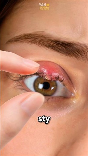 Never pop a stye on your eye ⁉️😱 #stye #medical #health