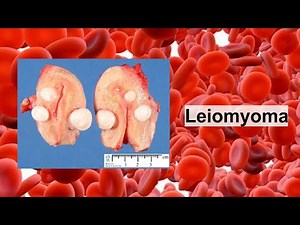 leiomyoma