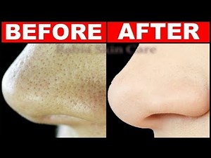 How To Get Rid of LARGE PORES in 3 Days || Best Home Remedies For Open Pores Treatment