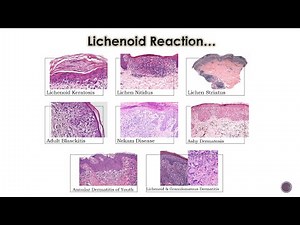 8- Lichenoid Dermatoses (2)
