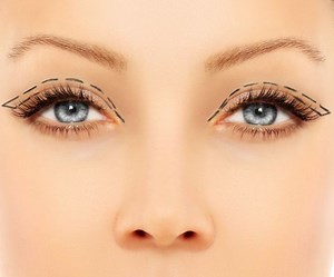 Eye Bag Removal - MyMediTravel Knowledge
