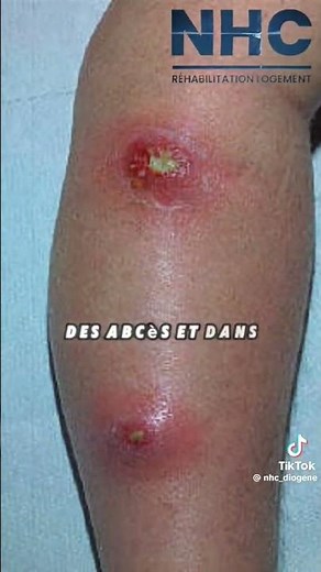 Staphylocoque Doré : le tueur silencieux ?😱😱 #science #information #conseils #doctor