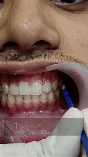 Topical Fluoride Application – Quick, Painless, and Effective!