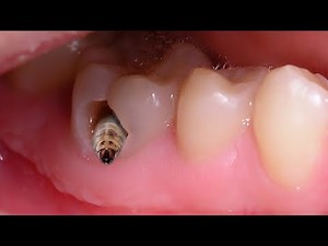 Trám răng sâu xoang 5 (fillings caries)