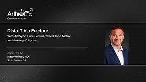 Distal Tibia Fracture With AlloSync™ Pure Demineralized Bone Matrix and the Angel® System