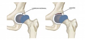 Rotura de Labrum – MEDS